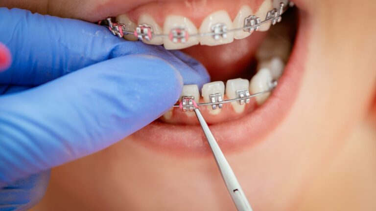 L’apparecchio per i denti aiuta tuo figlio a respirare meglio